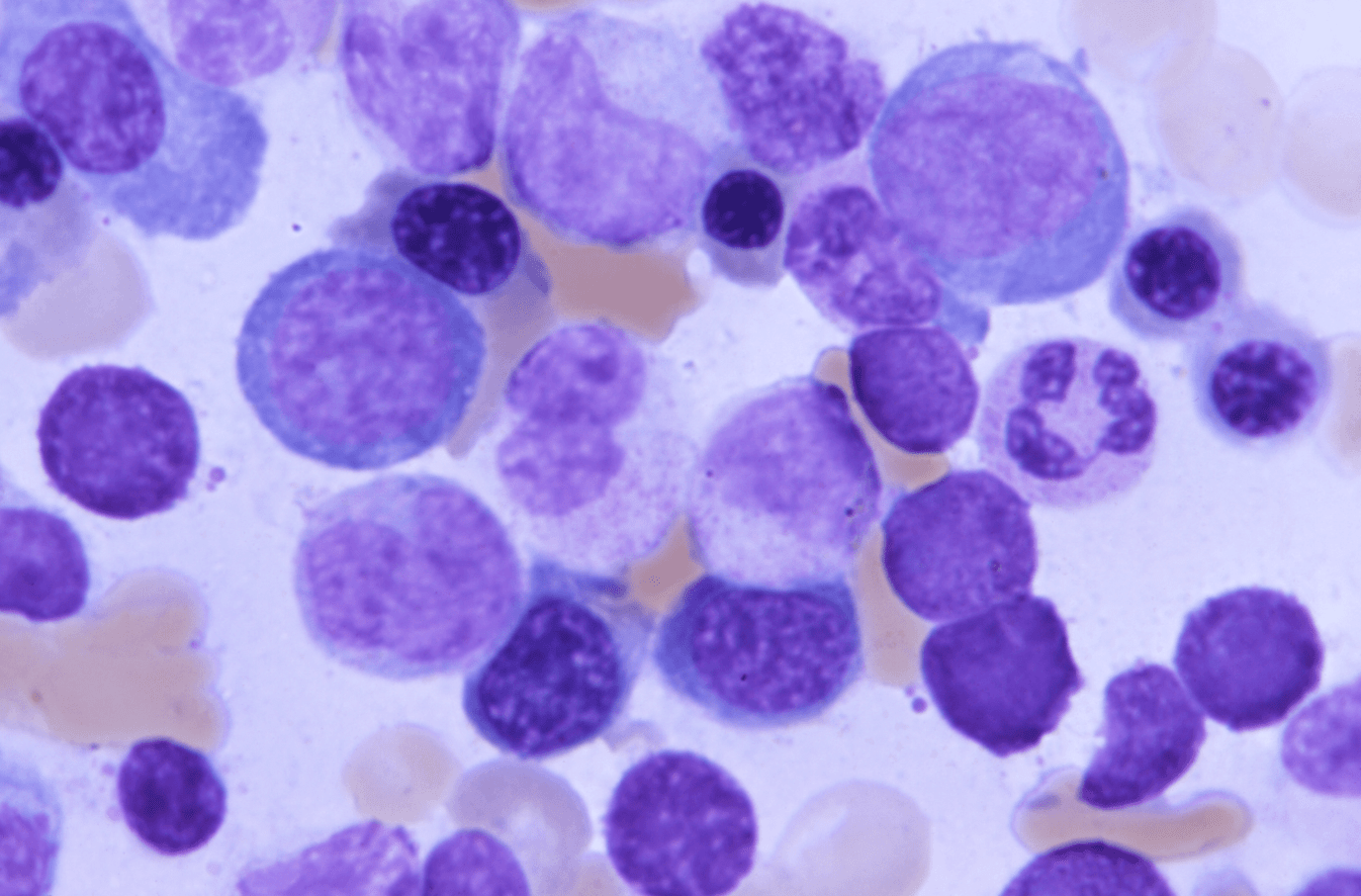 White blood cells in patient with acute leukemia